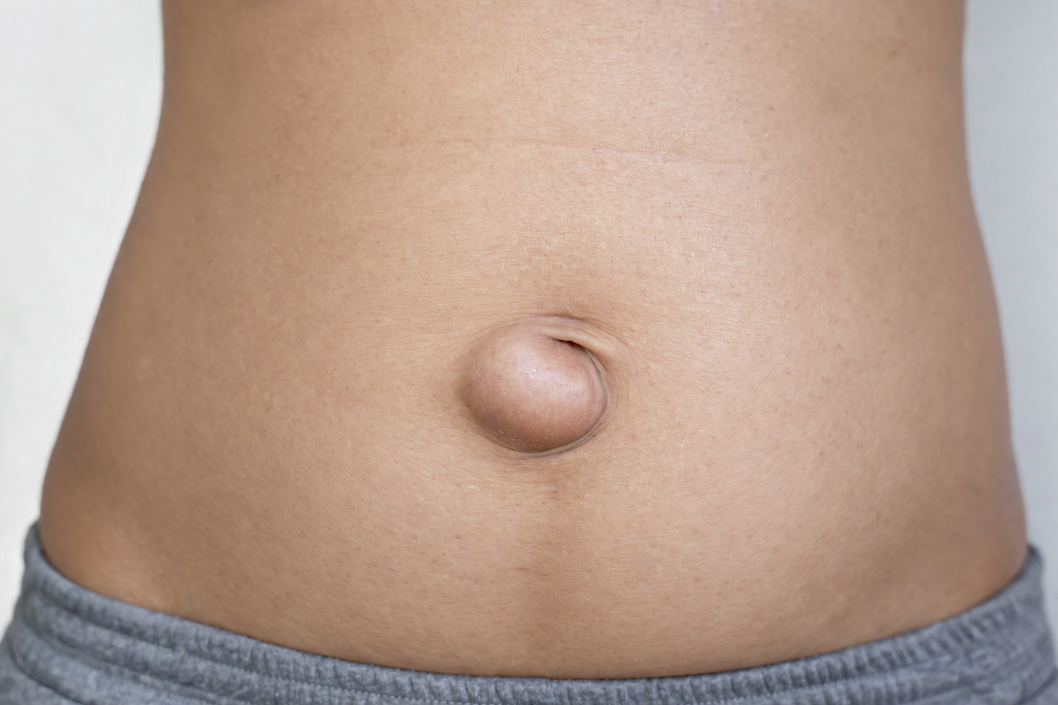 Umbilical Hernia in Adults: Symptoms, Causes and When to See a Surgeon
