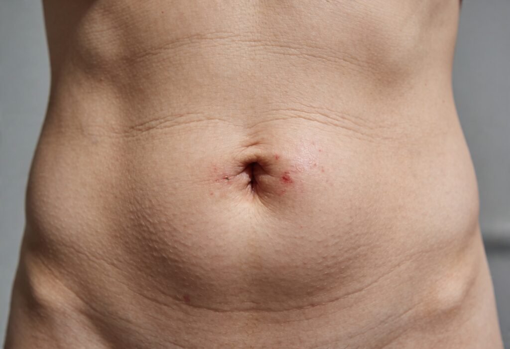 What Causes Hernias? Root Triggers, Risk Factors, and Modern Recovery Pathways